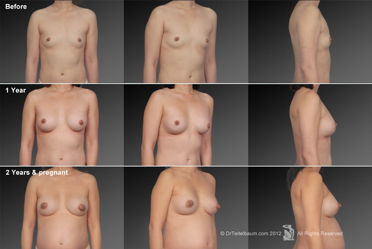 Breast Augmentation Before & After Gallery - Patient 104319616 - Image 1