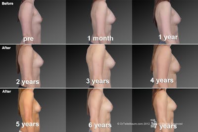 Breast Augmentation Before & After Gallery - Patient 104319646 - Image 1