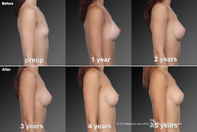 Breast Augmentation Before & After Gallery - Patient 104319648 - Image 1