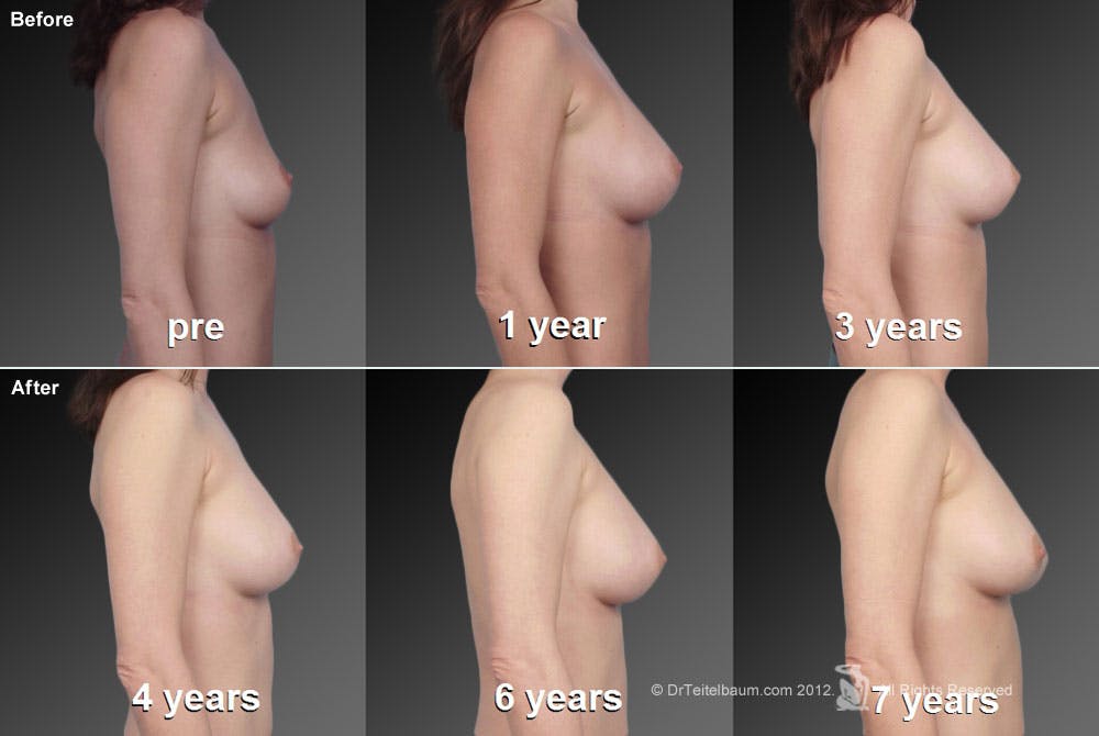 Breast Augmentation Before & After Gallery - Patient 104319993 - Image 1