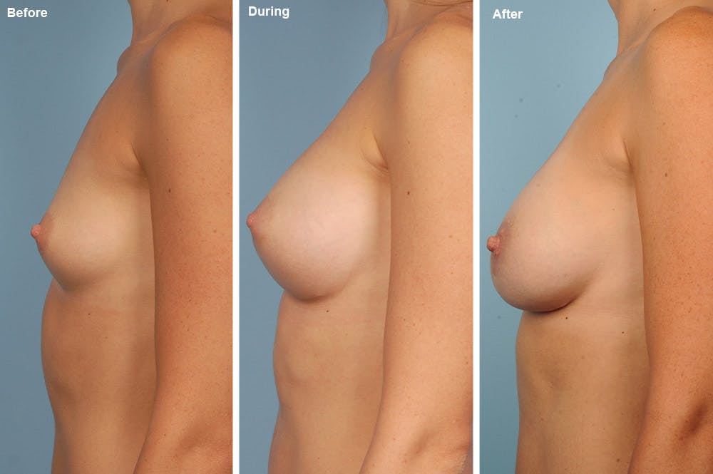Breast Augmentation Before & After Gallery - Patient 104322348 - Image 1