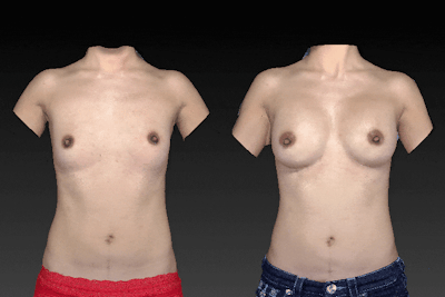 Breast Augmentation Before & After Gallery - Patient 104356137 - Image 1