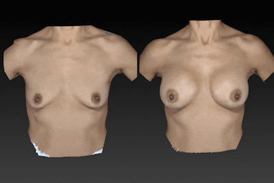 Breast Augmentation Before & After Gallery - Patient 104431220 - Image 1