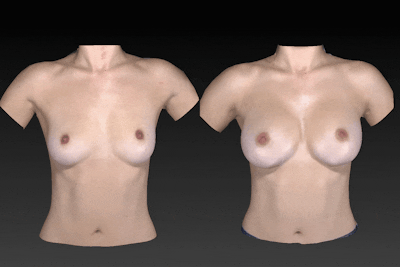 Breast Augmentation Before & After Gallery - Patient 104431219 - Image 1