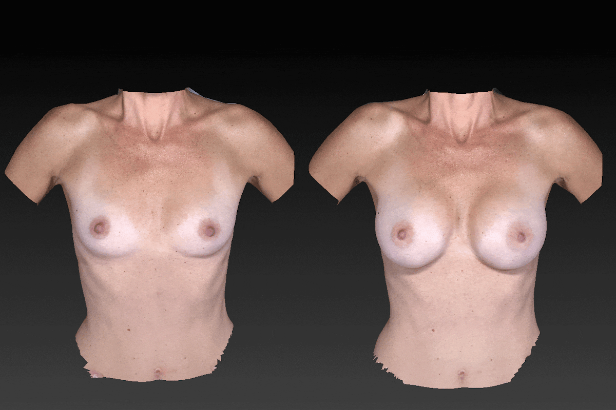 Breast Augmentation Before & After Gallery - Patient 104431218 - Image 1