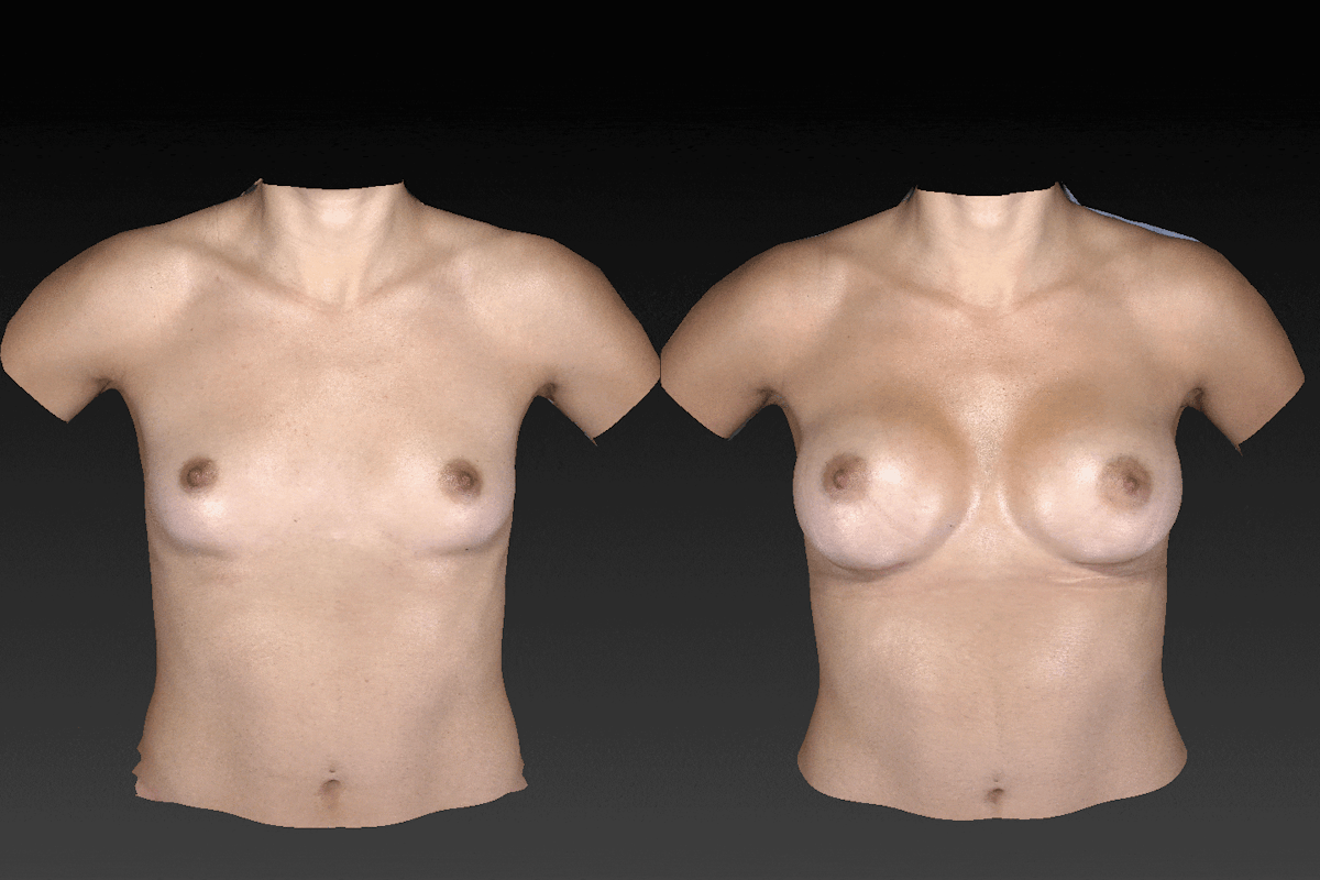 Breast Augmentation Before & After Gallery - Patient 104431217 - Image 1