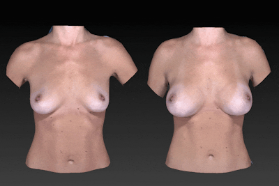 Breast Augmentation Before & After Gallery - Patient 104431216 - Image 1