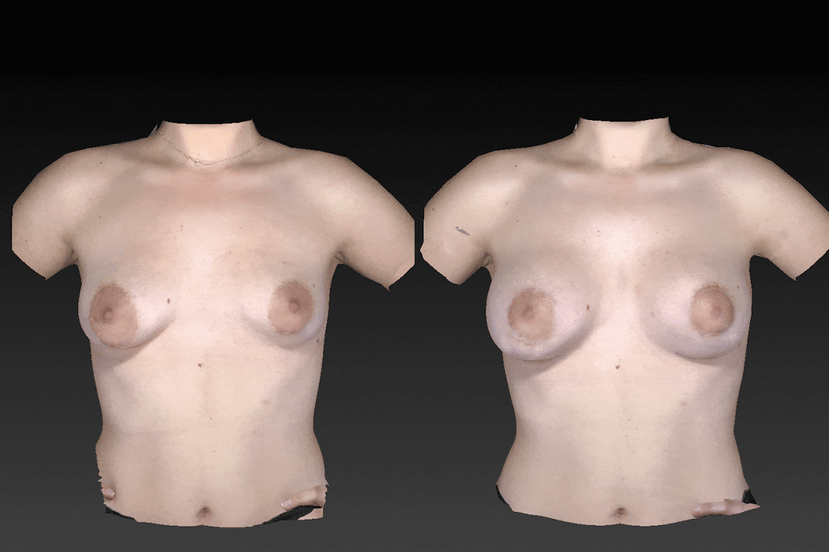 Breast Augmentation Before & After Gallery - Patient 104431215 - Image 1