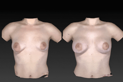 Breast Augmentation Before & After Gallery - Patient 104431215 - Image 1