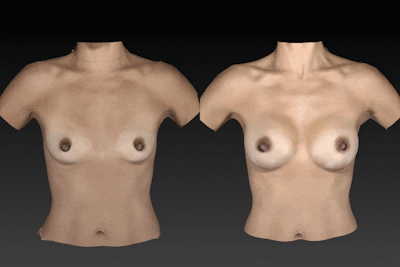 Breast Augmentation Before & After Gallery - Patient 104431214 - Image 1