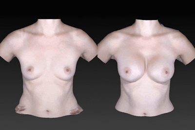 Breast Augmentation Before & After Gallery - Patient 104431213 - Image 1