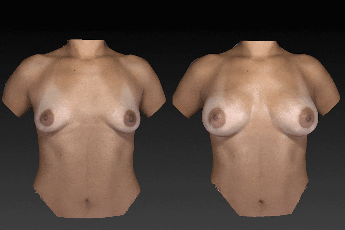 Breast Augmentation Before & After Gallery - Patient 104431212 - Image 1