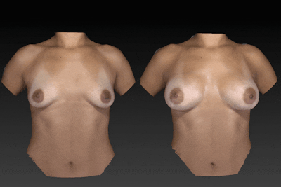Breast Augmentation Before & After Gallery - Patient 104431212 - Image 1