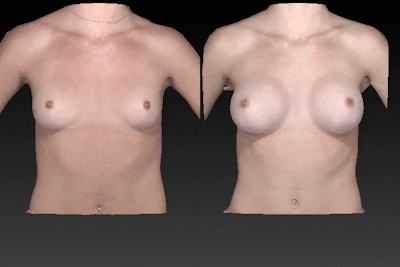 Breast Augmentation Before & After Gallery - Patient 104431210 - Image 1