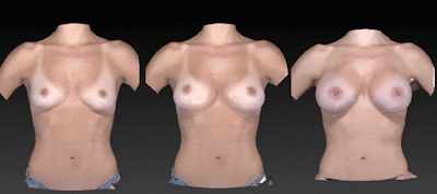 Breast Augmentation Before & After Gallery - Patient 104431209 - Image 1