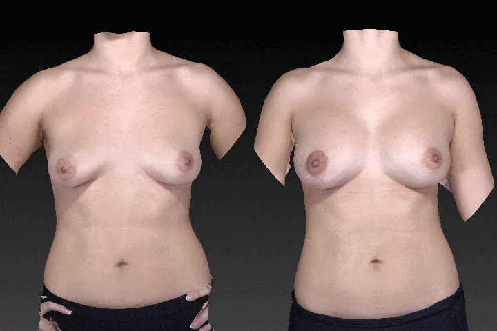 Breast Augmentation Before & After Gallery - Patient 104431208 - Image 1