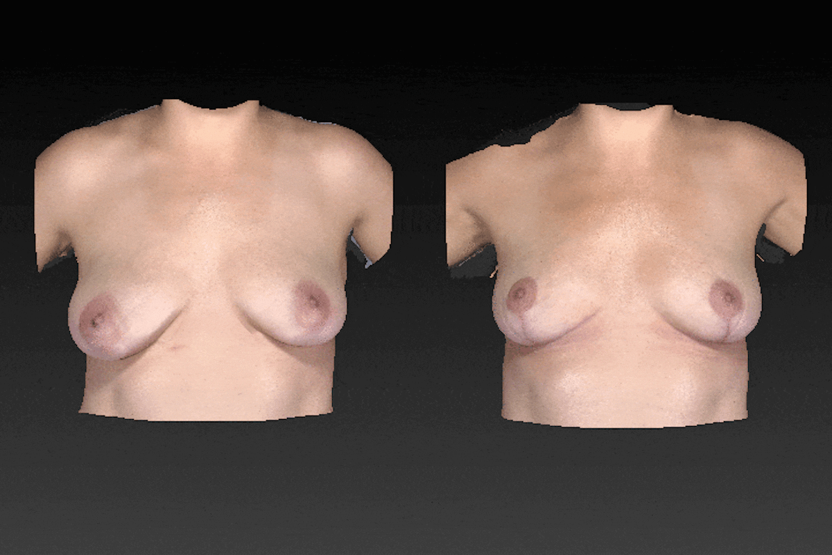 Breast Augmentation Before & After Gallery - Patient 104431207 - Image 1