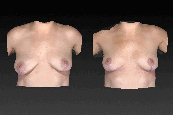 Breast Augmentation Before & After Gallery - Patient 104431207 - Image 1