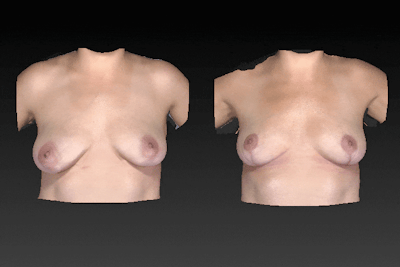 Breast Augmentation Before & After Gallery - Patient 104431207 - Image 1