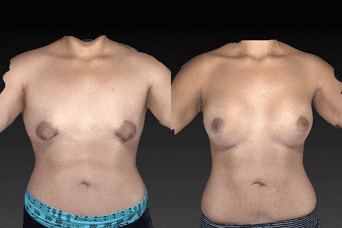 Breast Augmentation Before & After Gallery - Patient 104431206 - Image 1