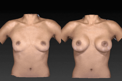 Breast Augmentation Before & After Gallery - Patient 104431204 - Image 1