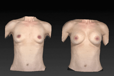 Breast Augmentation Before & After Gallery - Patient 104431202 - Image 1