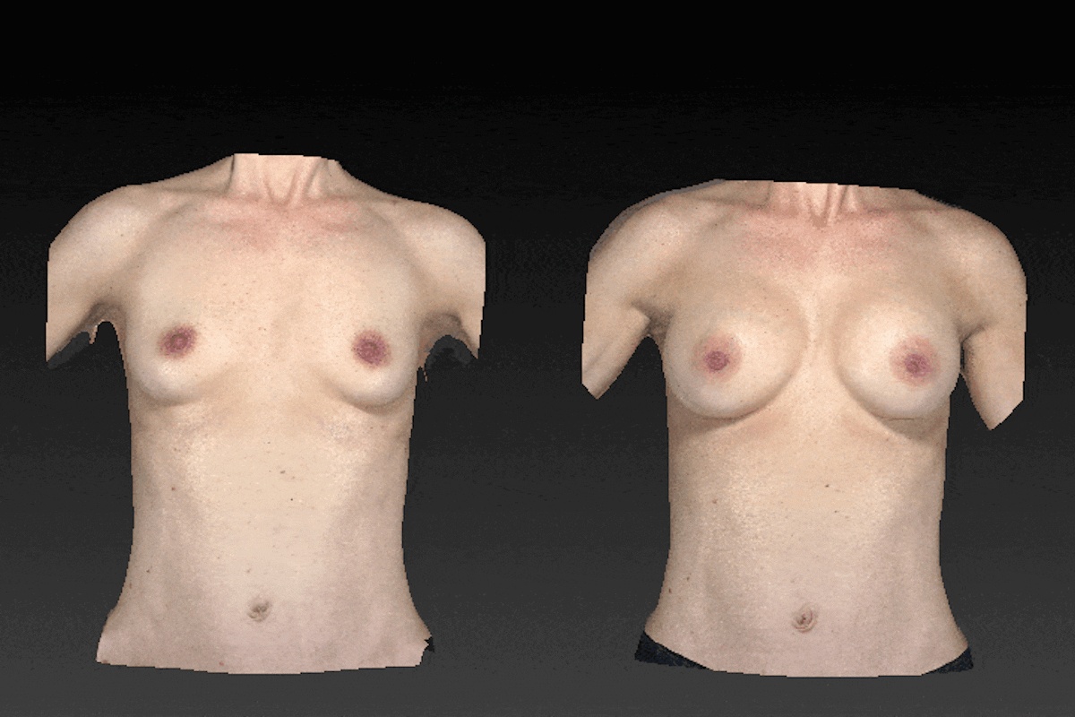 Breast Augmentation Before & After Gallery - Patient 104431203 - Image 1