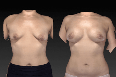Breast Augmentation Before & After Gallery - Patient 104431201 - Image 1