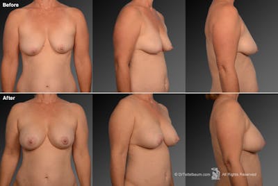 Breast Augmentation with Donut Lift Before & After Gallery - Patient 104440120 - Image 1