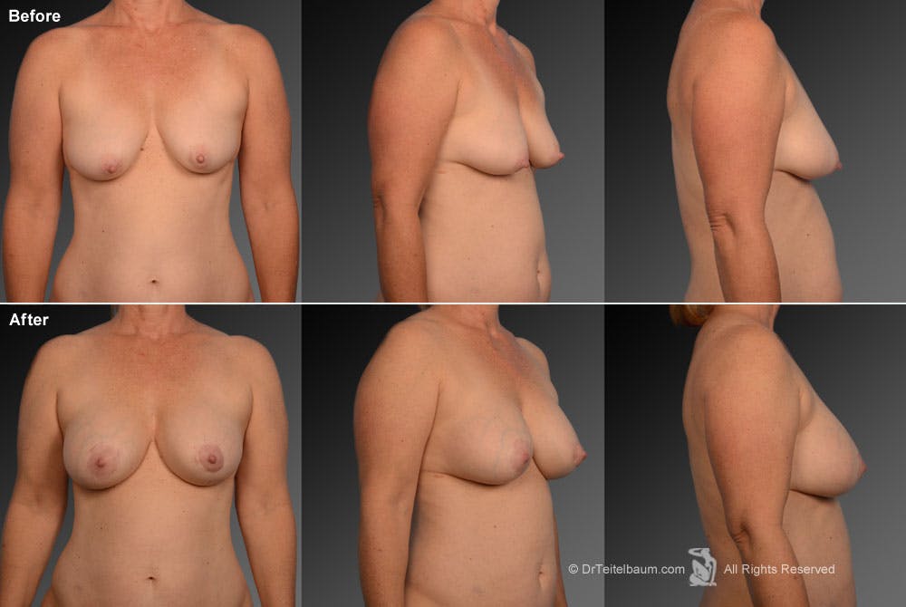 Breast Augmentation with Donut Lift Before & After Gallery - Patient 104440120 - Image 1
