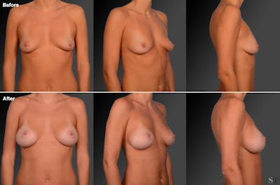 Breast Augmentation with Donut Lift Before & After Gallery - Patient 104440136 - Image 1