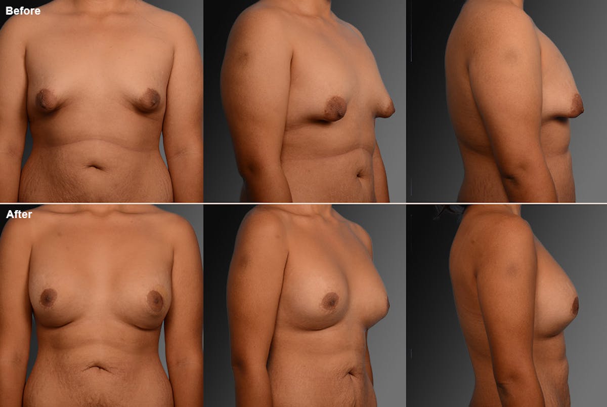 Breast Augmentation with Donut Lift Before & After Gallery - Patient 104440137 - Image 1