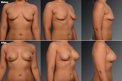 Breast Augmentation with Donut Lift Before & After Gallery - Patient 104440138 - Image 1