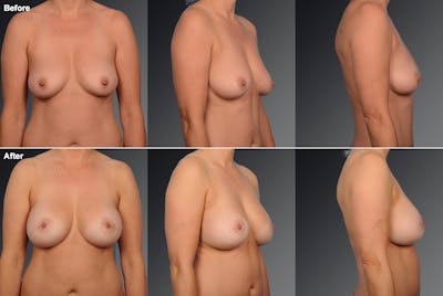 Breast Augmentation with Donut Lift Before & After Gallery - Patient 104440139 - Image 1