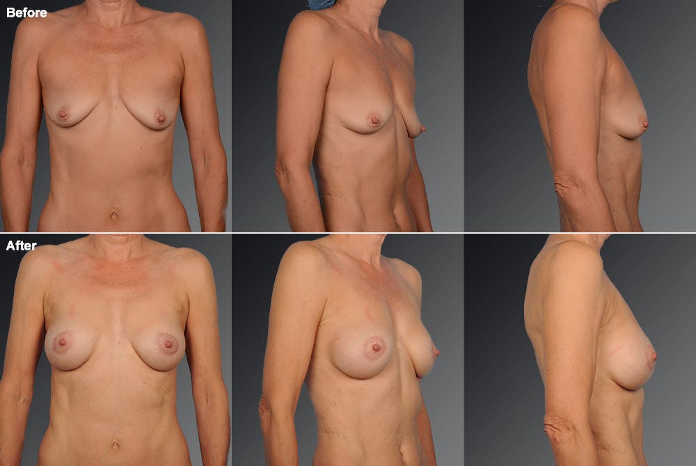 Breast Augmentation with Donut Lift Before & After Gallery - Patient 104440140 - Image 1