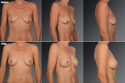 Breast Augmentation with Donut Lift Before & After Gallery - Patient 104440140 - Image 1