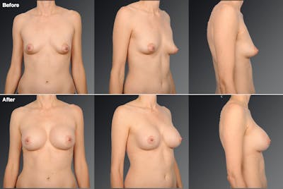 Breast Augmentation with Donut Lift Before & After Gallery - Patient 104440162 - Image 1