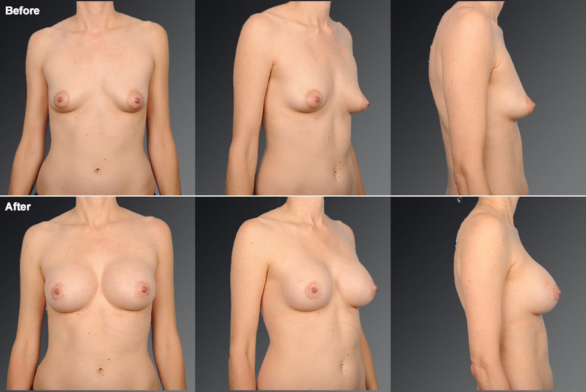 Breast Augmentation with Donut Lift Before & After Gallery - Patient 104440162 - Image 1