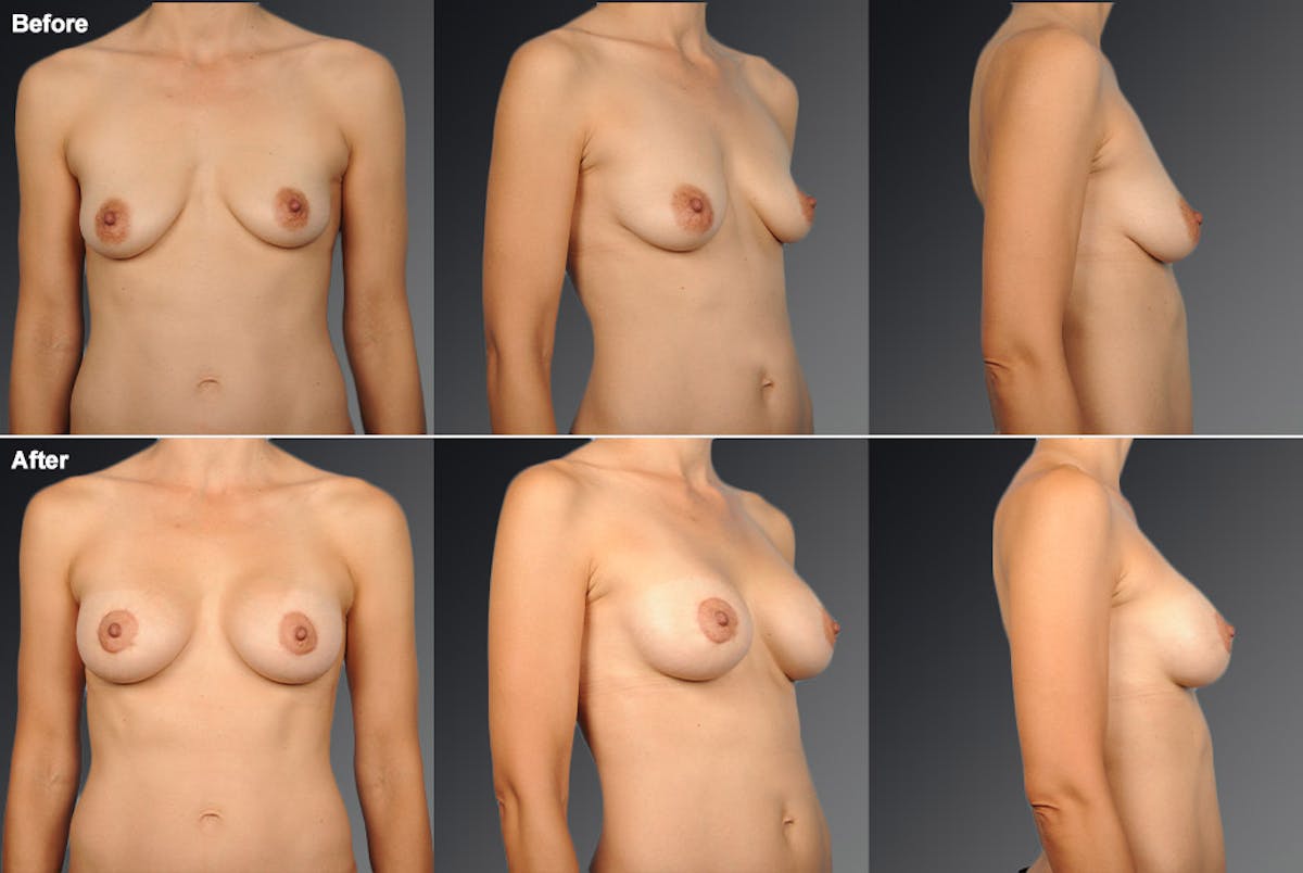 Breast Augmentation with Donut Lift Before & After Gallery - Patient 104440164 - Image 1