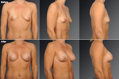 Breast Augmentation with Donut Lift Before & After Gallery - Patient 104440166 - Image 1