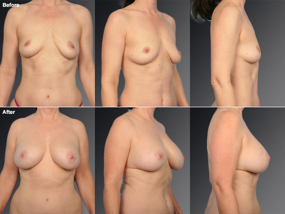 Breast Augmentation with Donut Lift Before & After Gallery - Patient 104440167 - Image 1