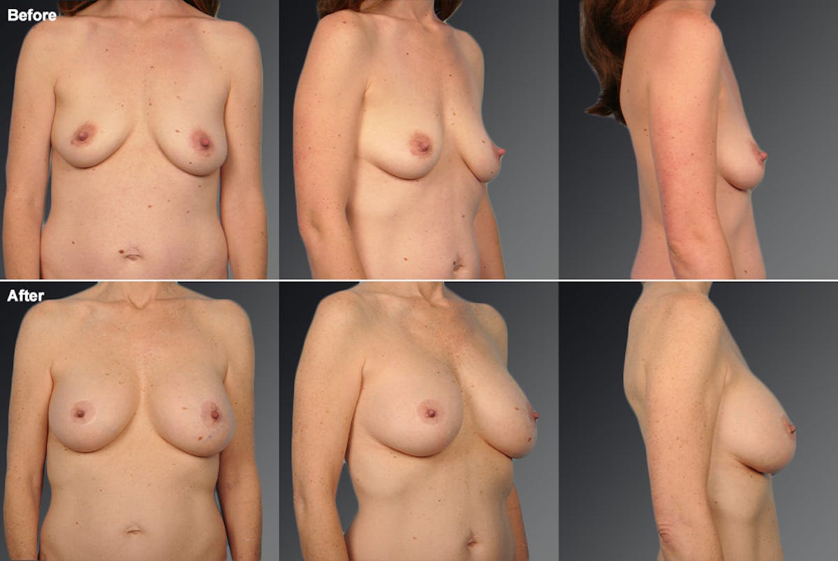 Breast Augmentation with Donut Lift Before & After Gallery - Patient 104440168 - Image 1