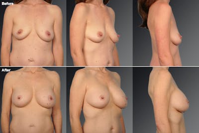 Breast Augmentation with Donut Lift Before & After Gallery - Patient 104440168 - Image 1