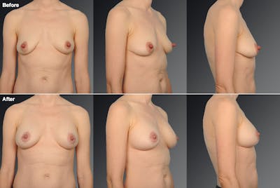 Breast Augmentation with Donut Lift Before & After Gallery - Patient 104440174 - Image 1