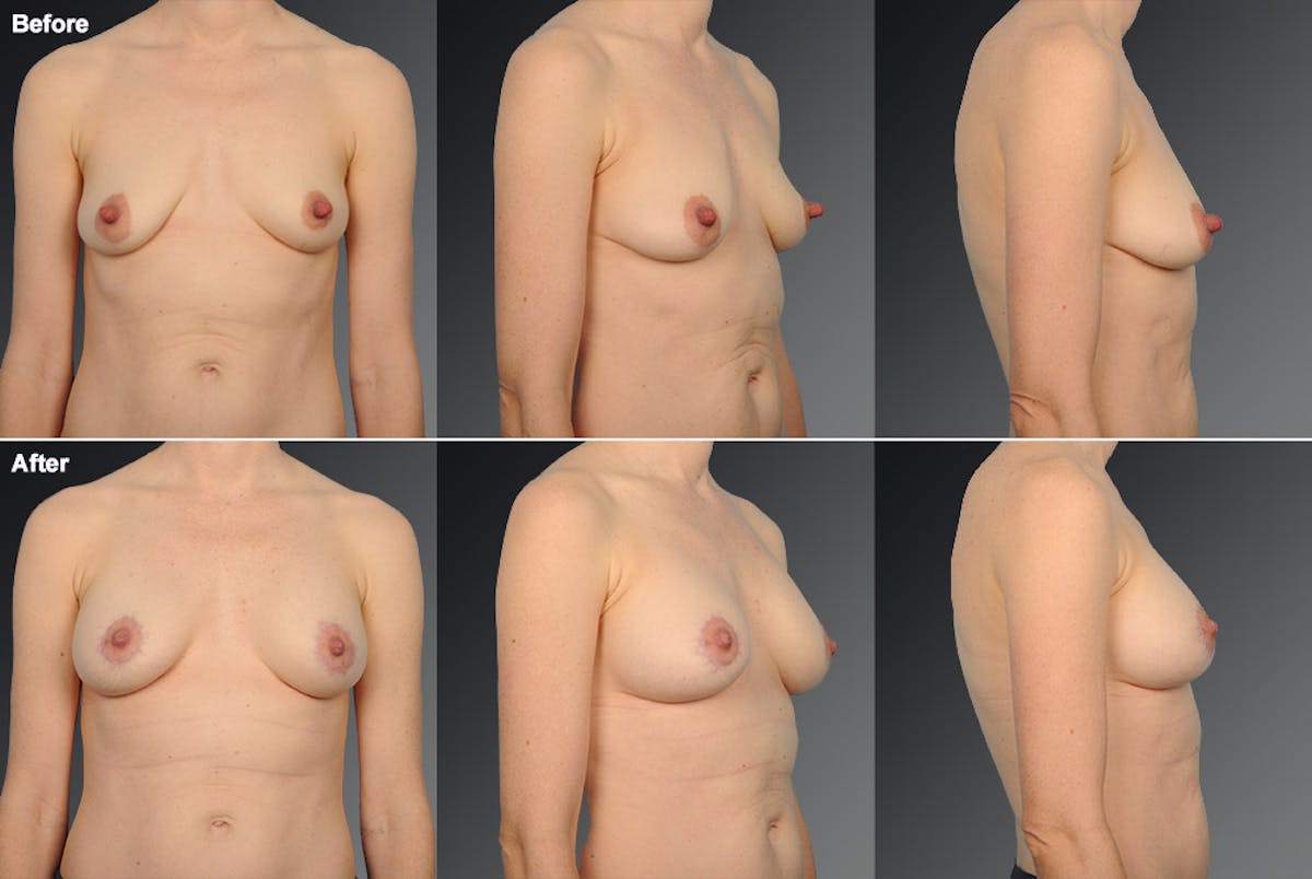 Breast Augmentation with Donut Lift Before & After Gallery - Patient 104440174 - Image 1