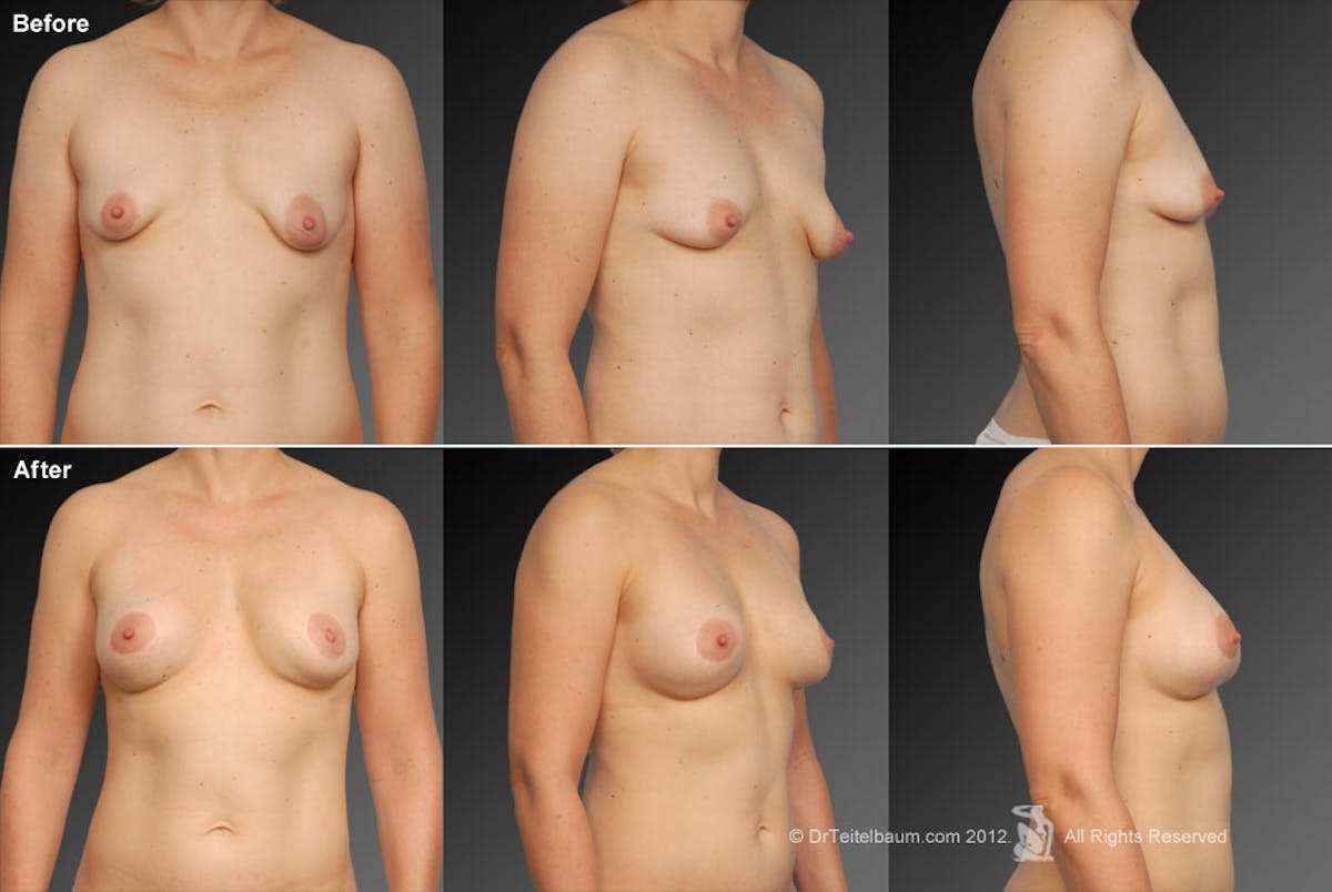 Breast Augmentation with Donut Lift Before & After Gallery - Patient 104440869 - Image 1