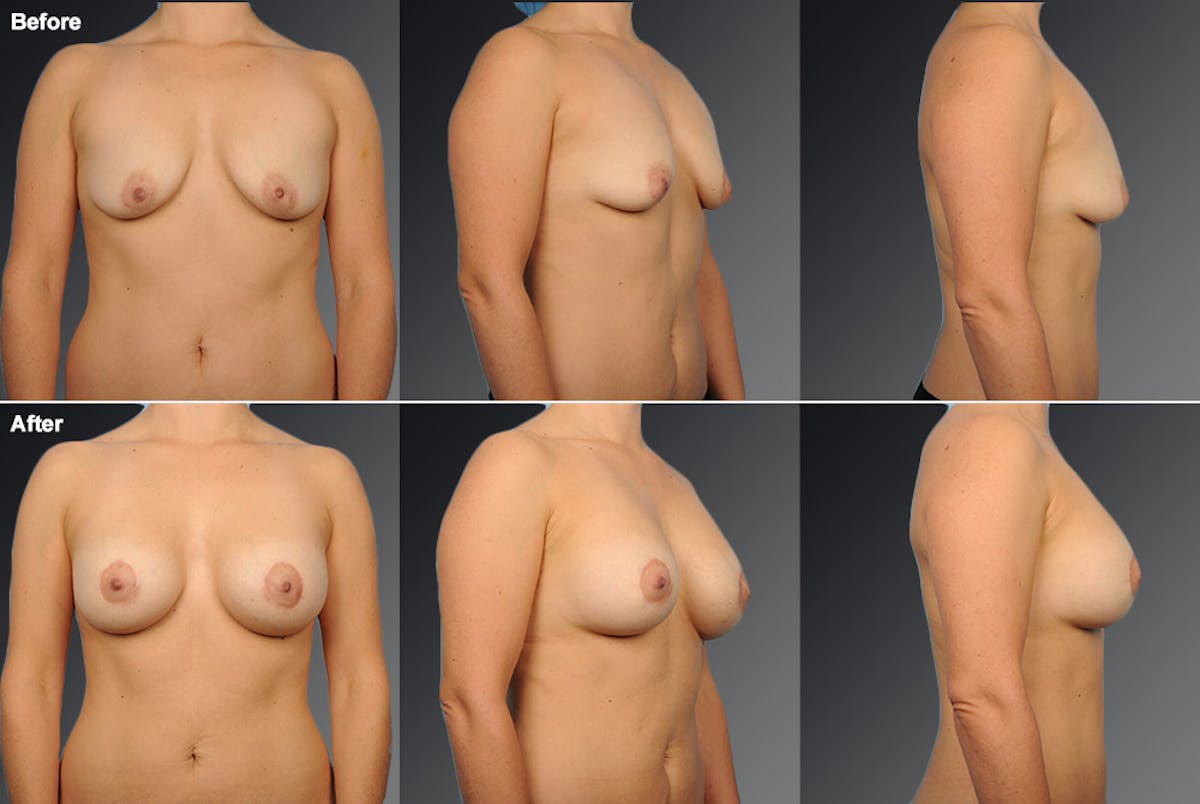 Breast Augmentation with Donut Lift Before & After Gallery - Patient 104456167 - Image 1