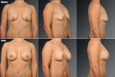 Breast Augmentation with Donut Lift Before & After Gallery - Patient 104456167 - Image 1