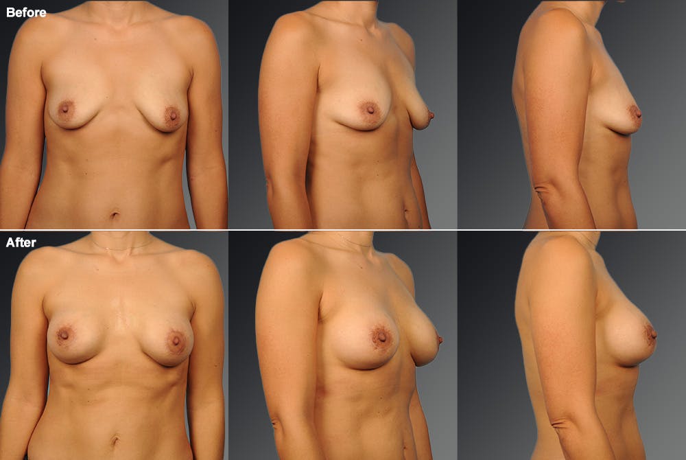Breast Augmentation with Donut Lift Before & After Gallery - Patient 104462637 - Image 1