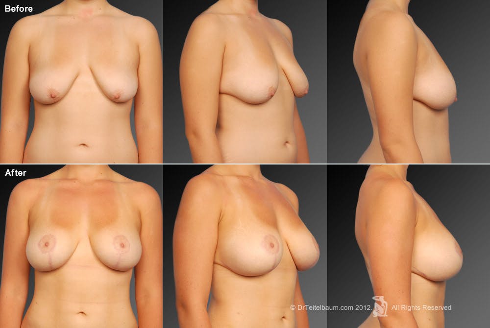 Breast Augmentation with Anchor Lift Before & After Gallery - Patient 105454225 - Image 1